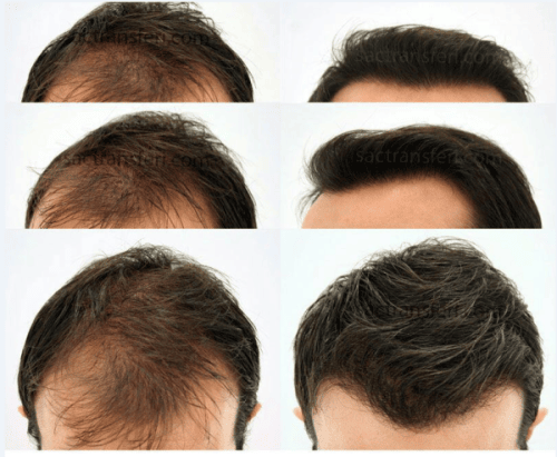 Before and after image showing the progress of a hair transplant.