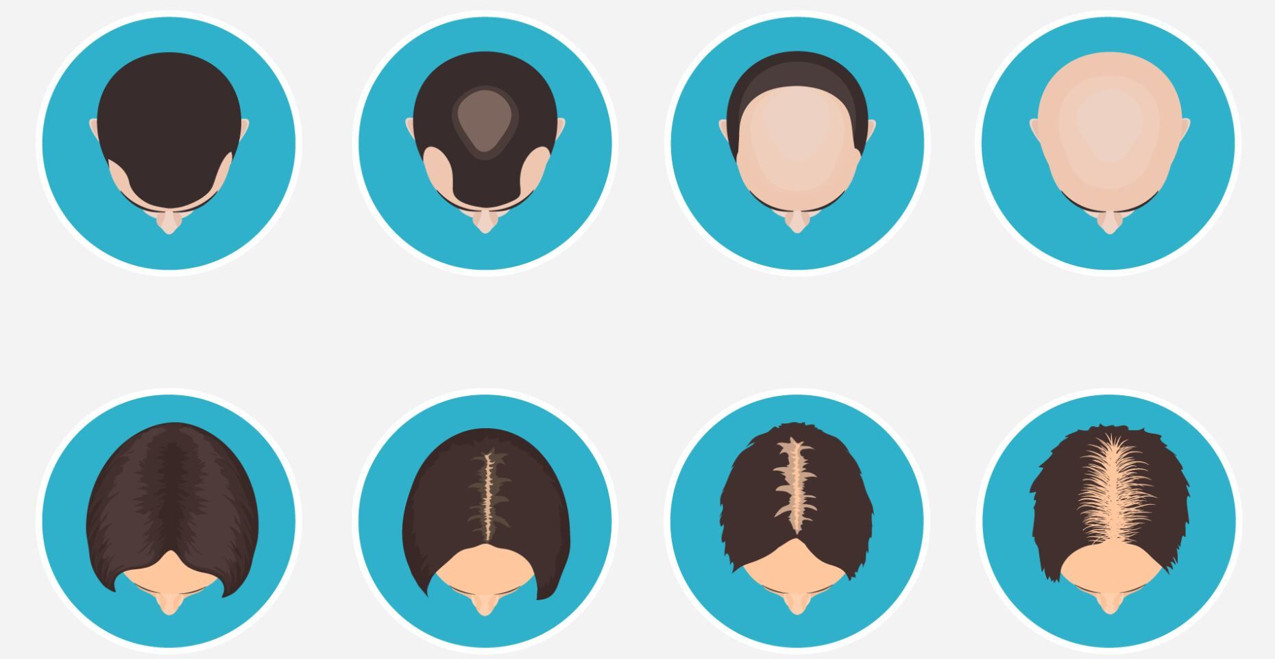 Vorher-Nachher-Bild, das den Verlauf einer Haartransplantation zeigt.