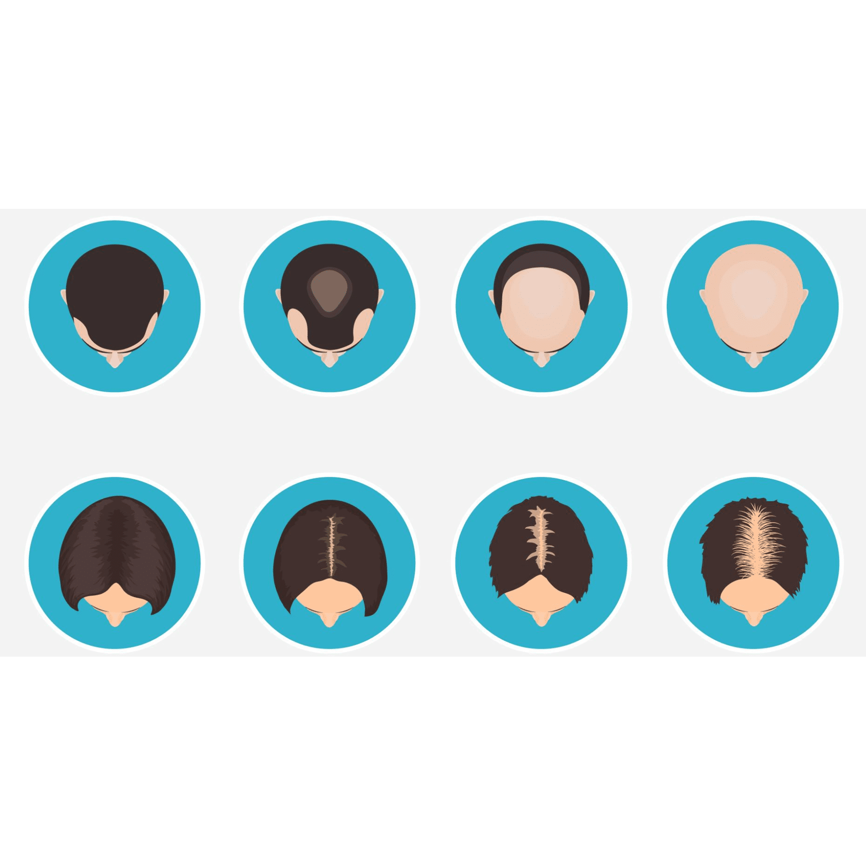 Vorher-Nachher-Bild, das den Verlauf einer Haartransplantation zeigt.