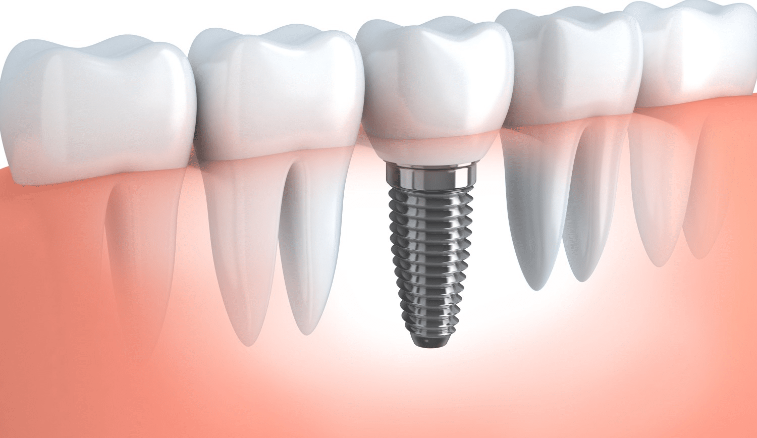 EN image 1 for Dental Implant Cost Guide
