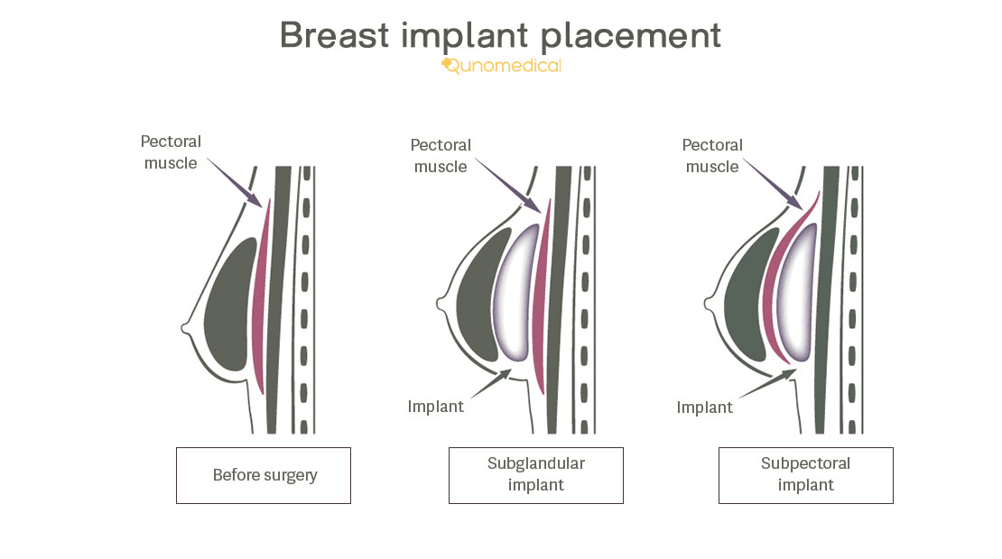 The areas where you can have your breast implant placed 