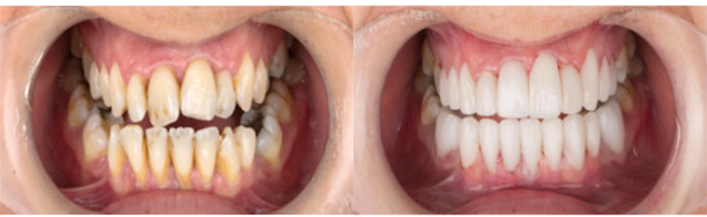 Patient zeigt seine Zähne vor und nach einer Behandlung mit Veneers.