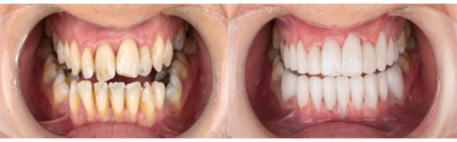 Patient showing teeth before and after having dental veneers fitted.
