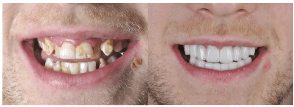 Patient zeigt seine Zähne vor und nach einer Behandlung mit Veneers.
