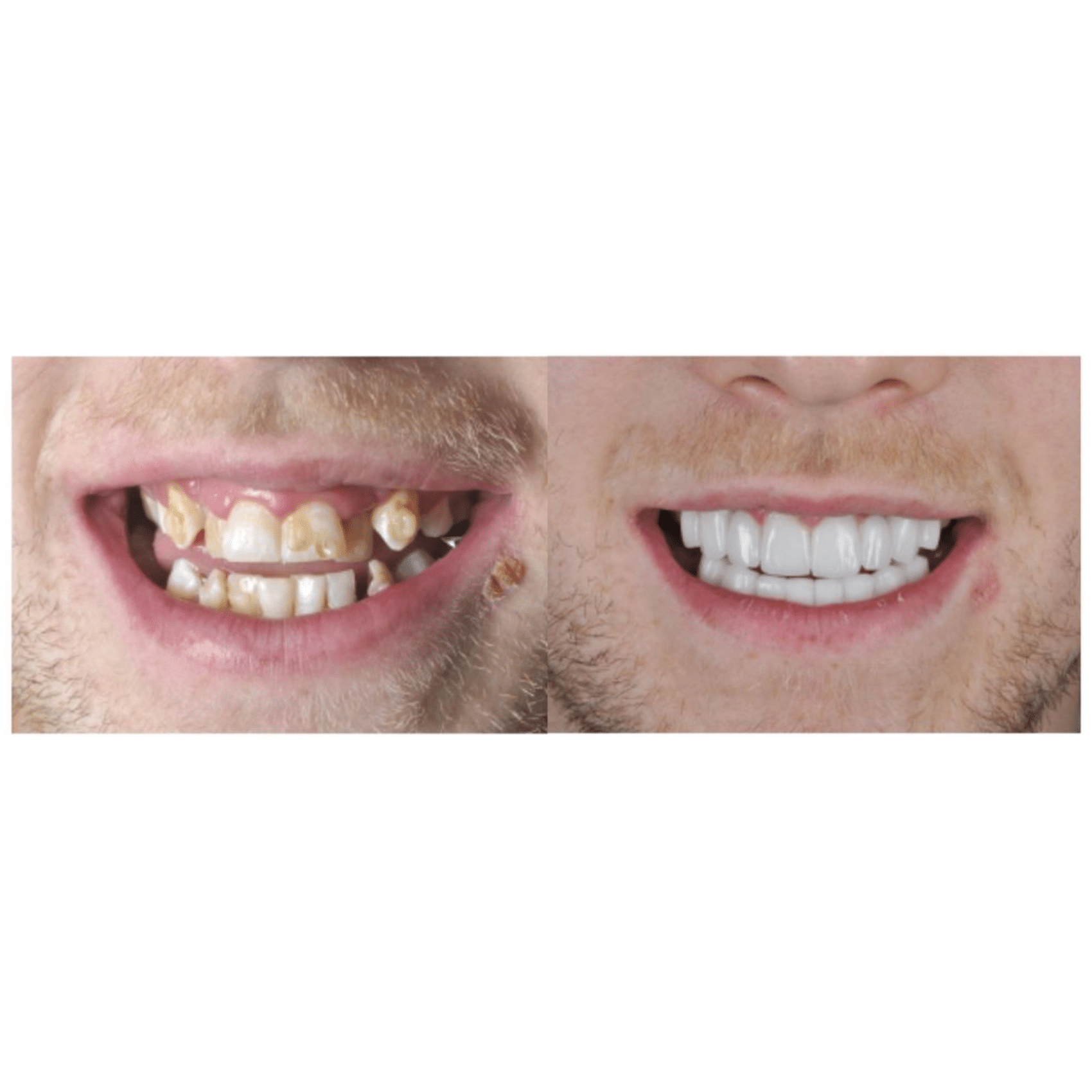 Patient showing teeth before and after having dental veneers fitted.