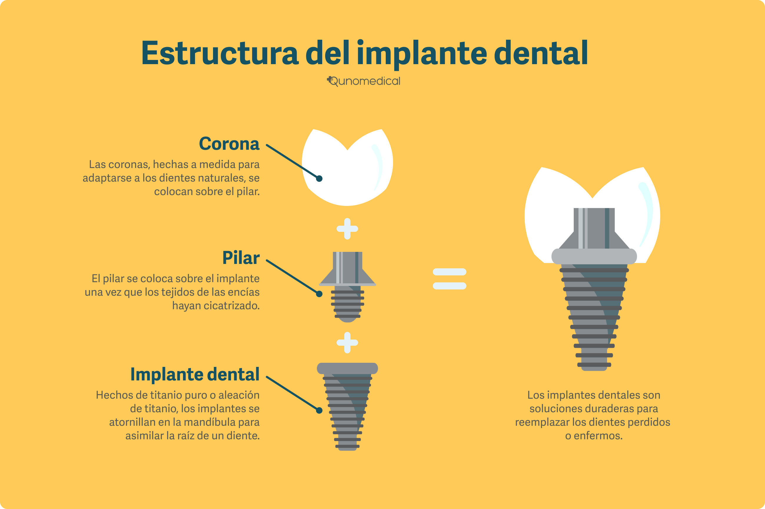 Diagrama mostrando la estructura de un implante dental.