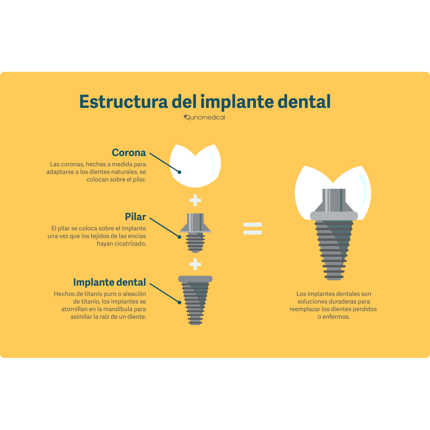 Diagrama mostrando la estructura de un implante dental.