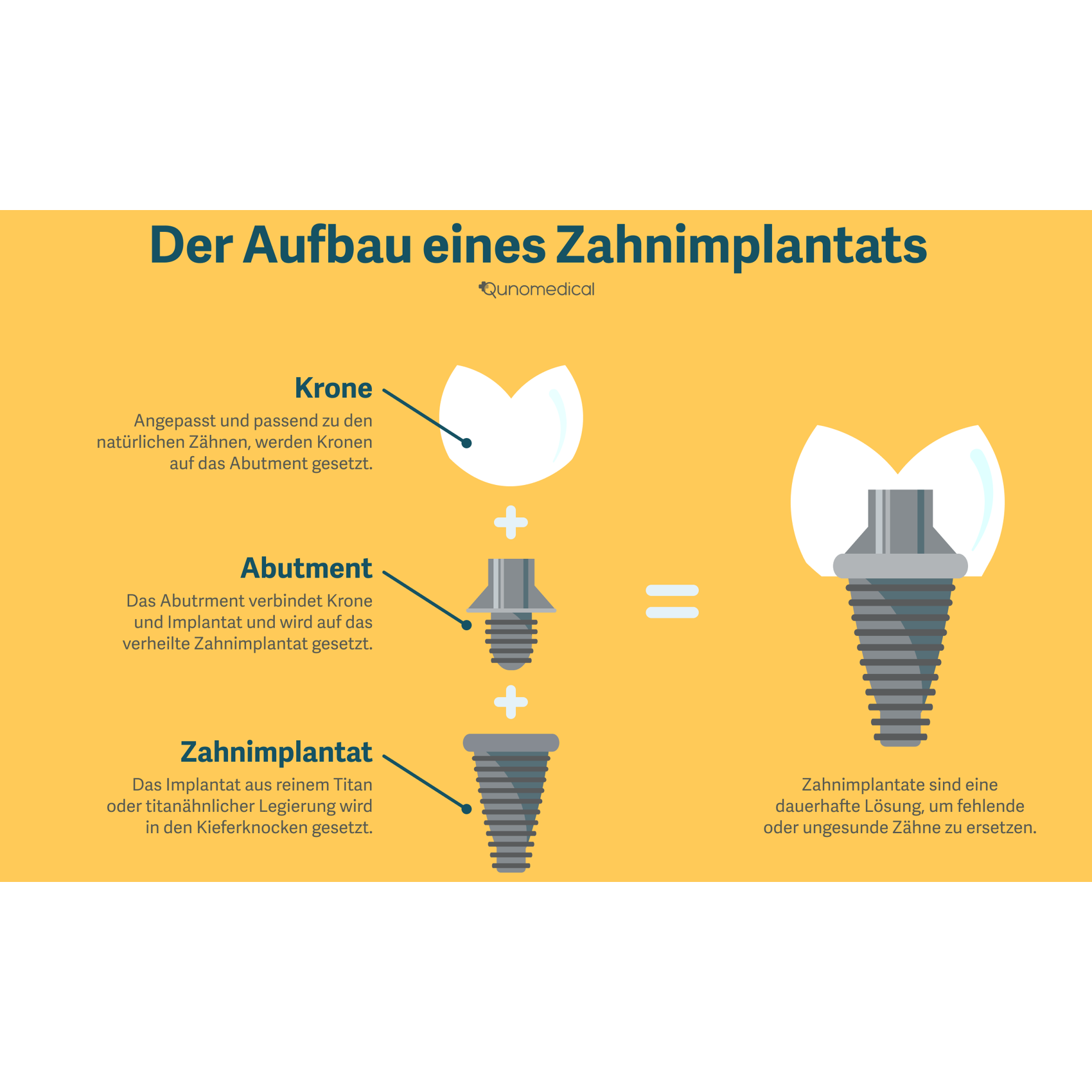 Diagramm zeigt den Aufbau eines Zahnimplantats.
