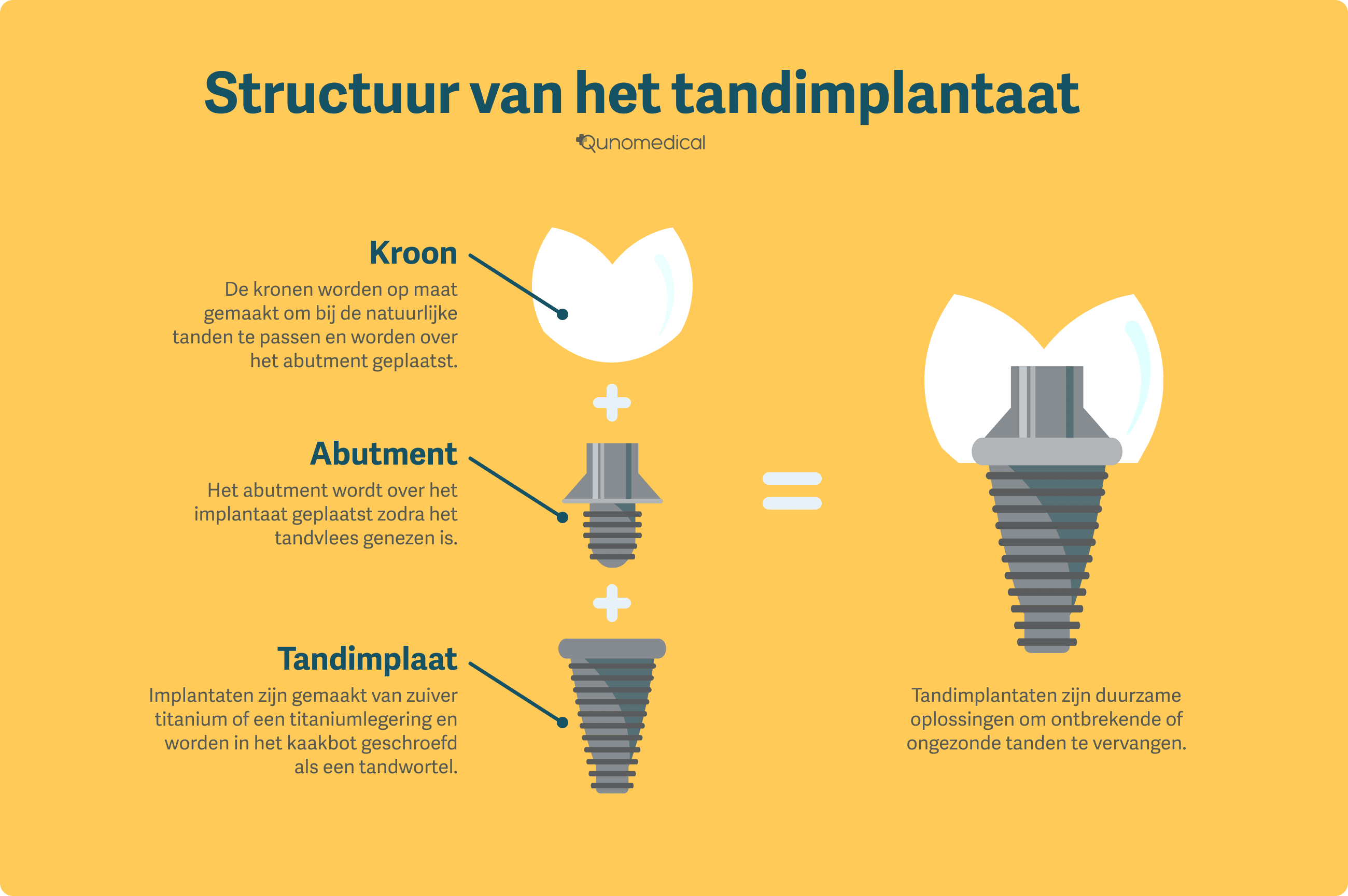 Diagram laat structuur van tandimplantaat zien.