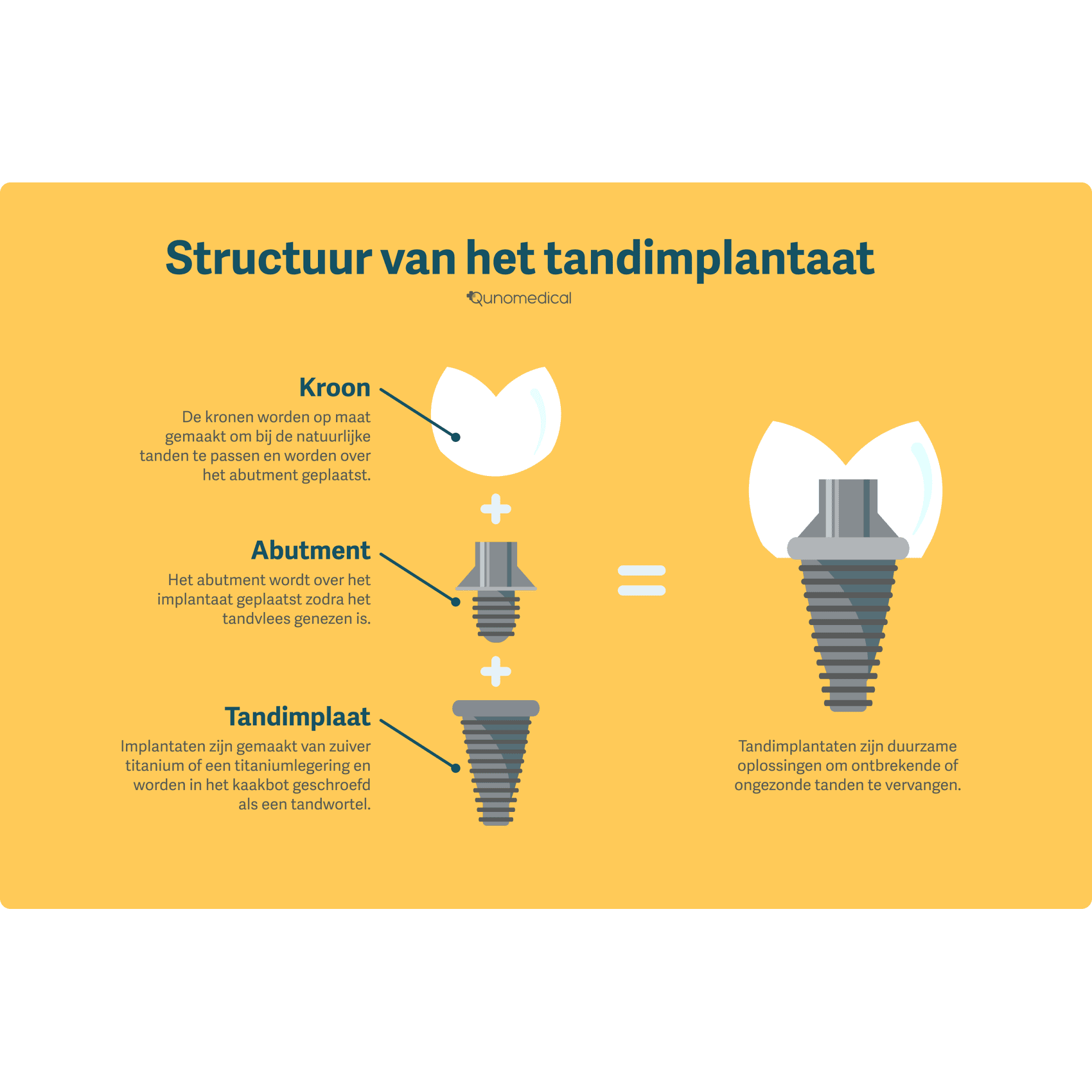 Diagram laat structuur van tandimplantaat zien.