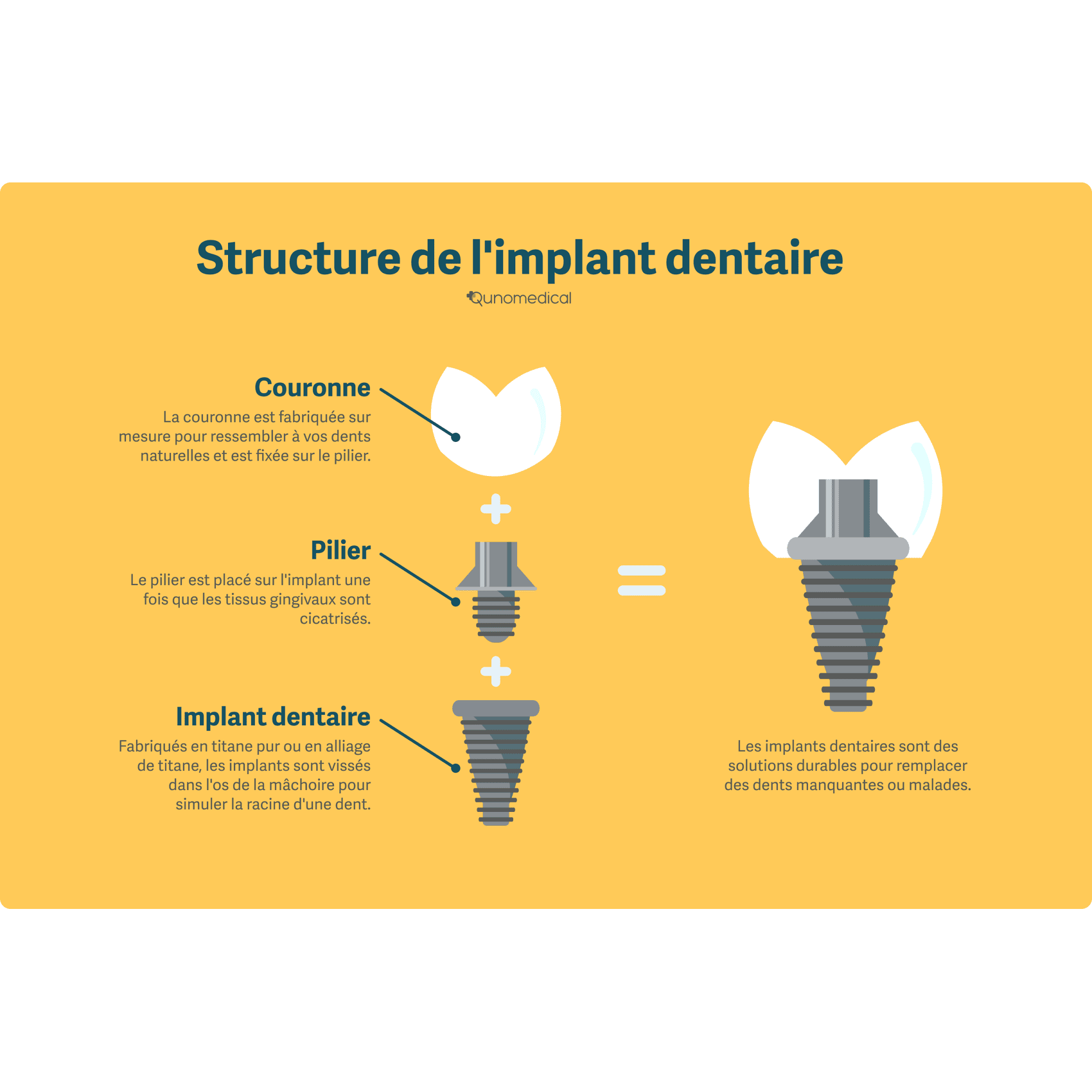 Structure d'un implant dentaire.