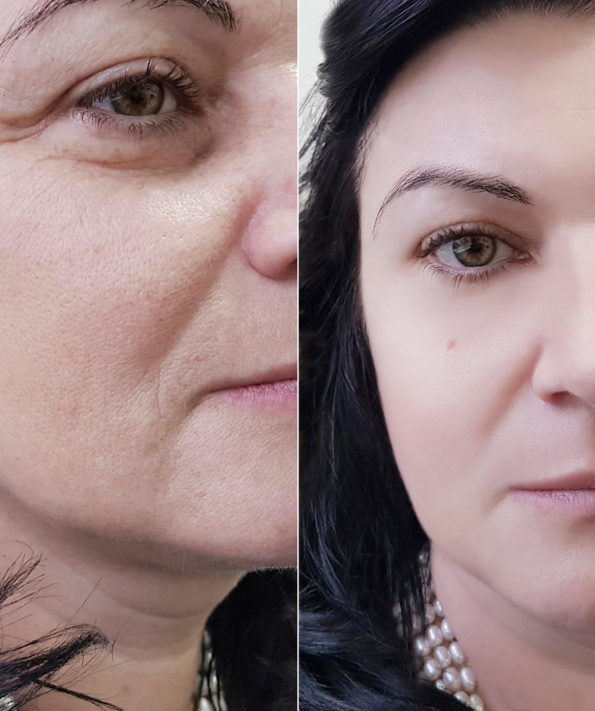 EN image 4 for Blepharoplasty Cost Guide