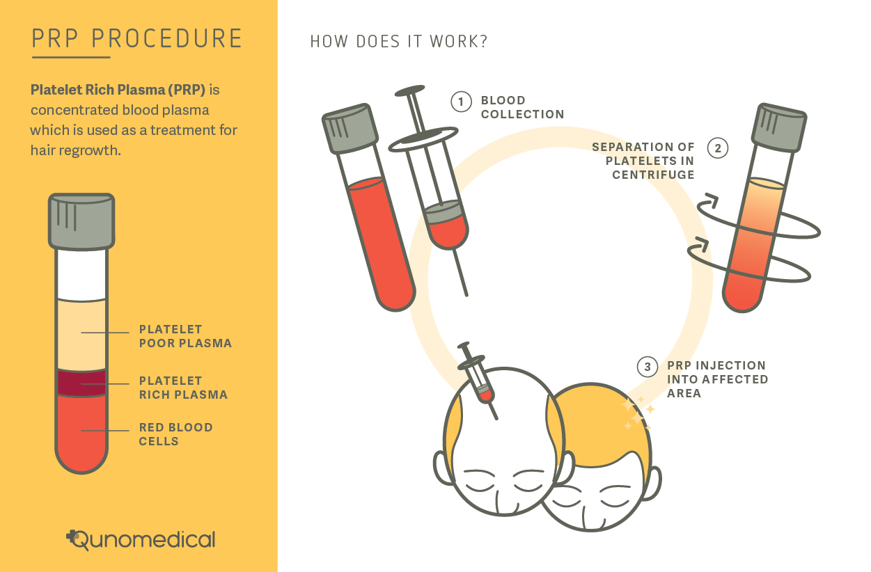 A diagram showing the role of platelet rich plasma guide hair restoration surgery.