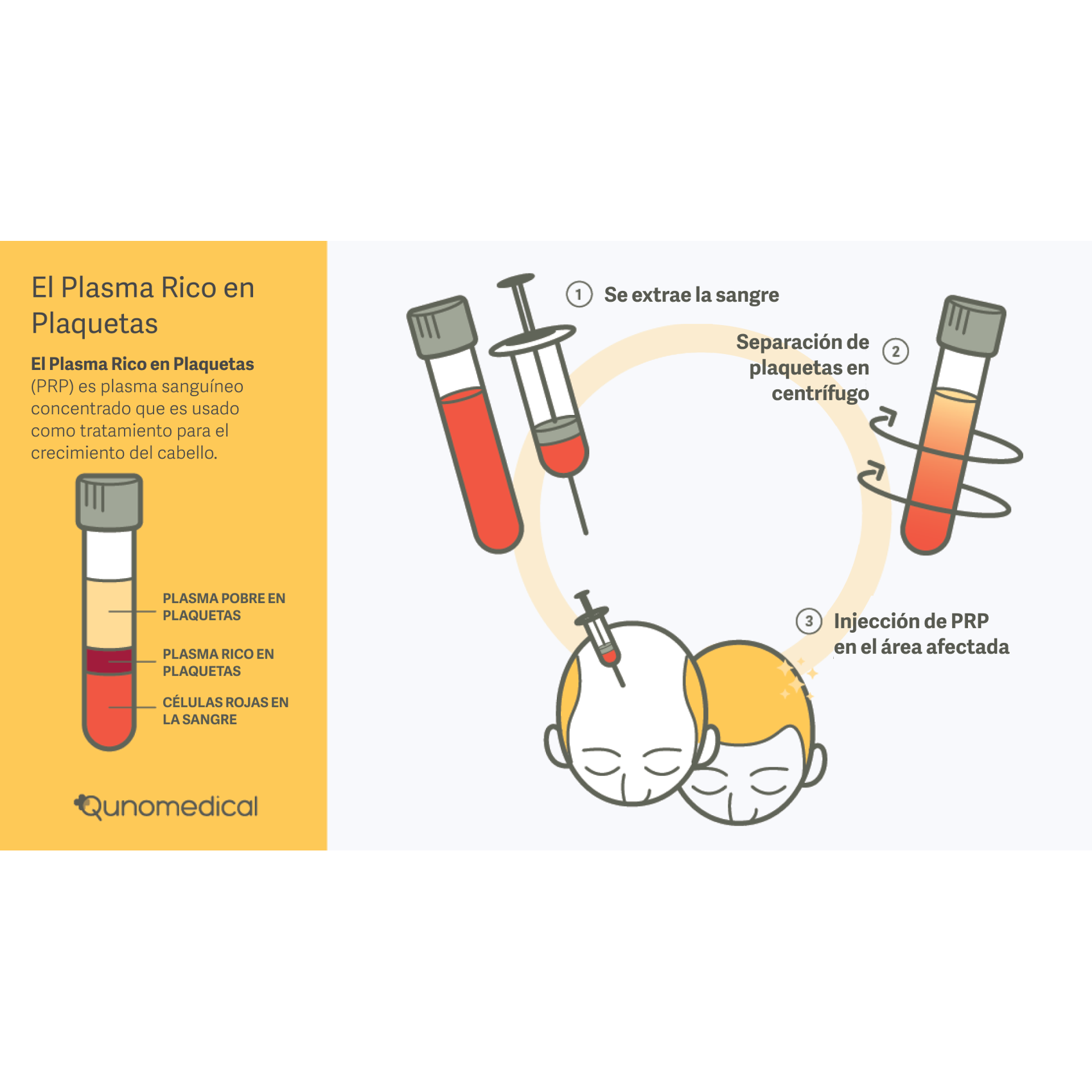 Diagrama que muestra el rol del plasma rico en plaquetas en la cirugía de restauración de cabello.