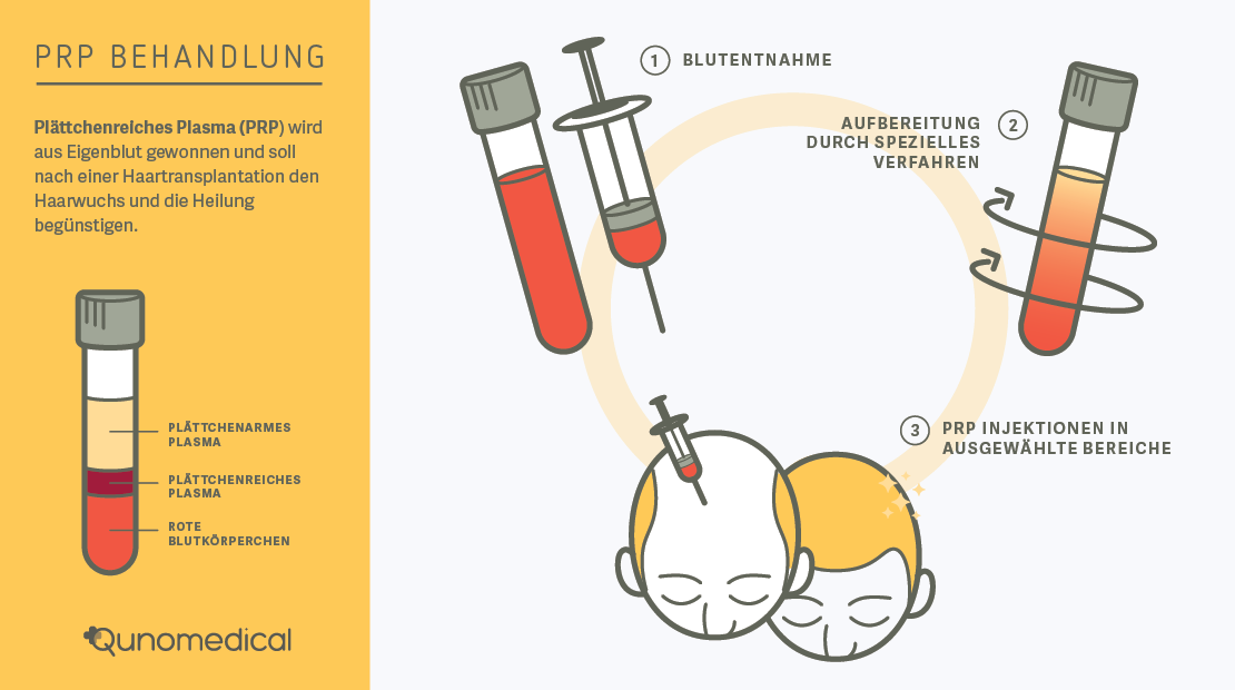 Ein Diagramm, das die Rolle der plättchenreichen Plasma-Leitfaden-Haarwiederherstellungschirurgie zeigt.