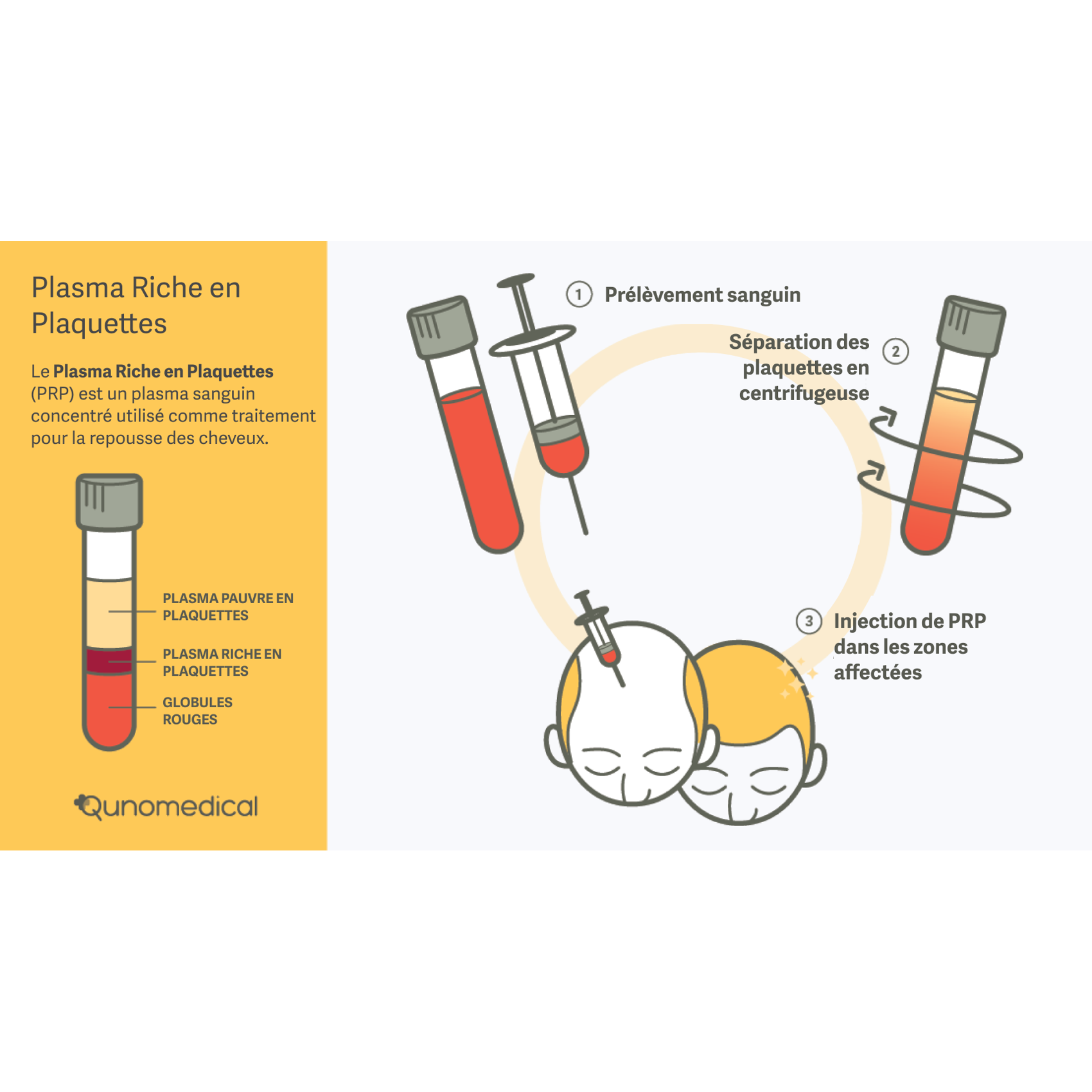Diagramme montrant le rôle du plasma riche en plaquettes dans la greffe de cheveux.