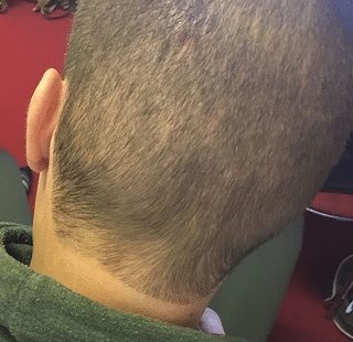 Image4_Patient Stories: Charles’s Hair Transplant - 5 Months Later