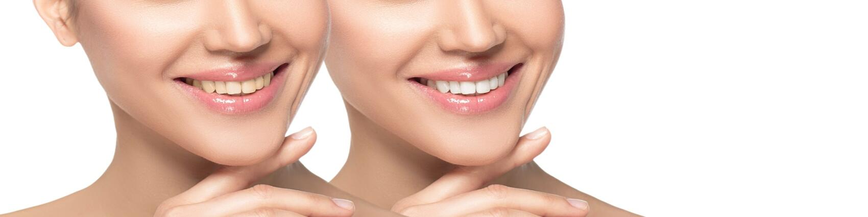 Woman smiling before and after having veneers fitted.
