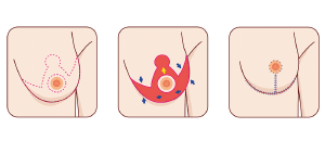 Diagram showing procedure of breast reduction treatments.