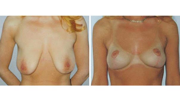 Woman facing camera showing breasts before and after undergoing breast lift surgery.