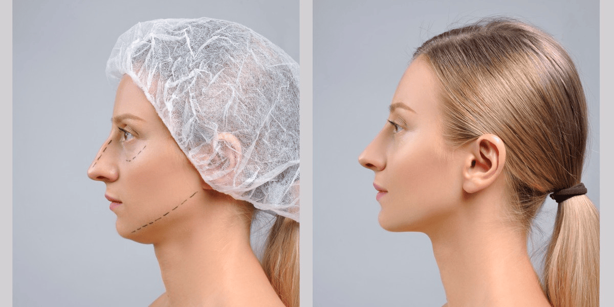 Image of a woman before and after a nose job