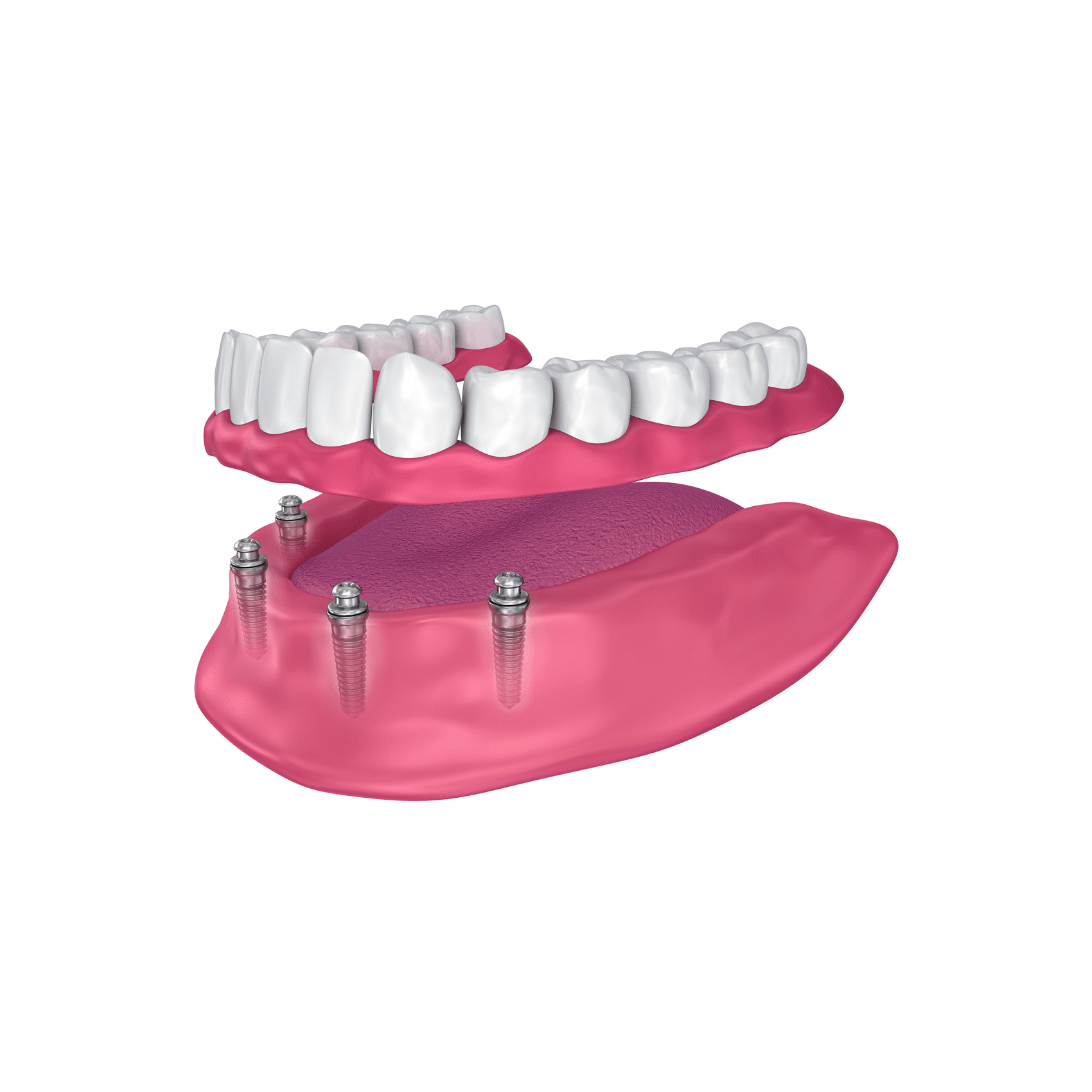 Imagen 3D de implantes dentales all-on-4.