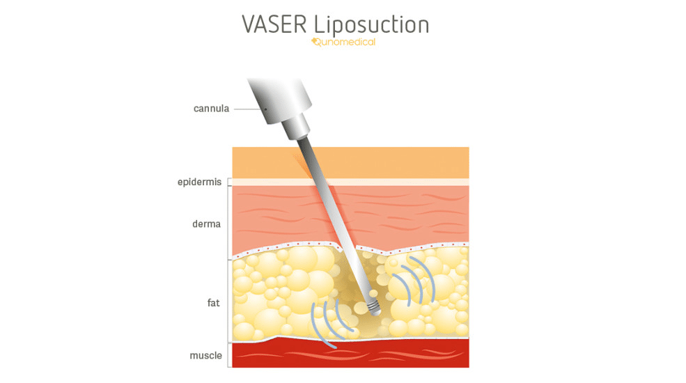 Illustration showing how a VASER liposuction procedure works.