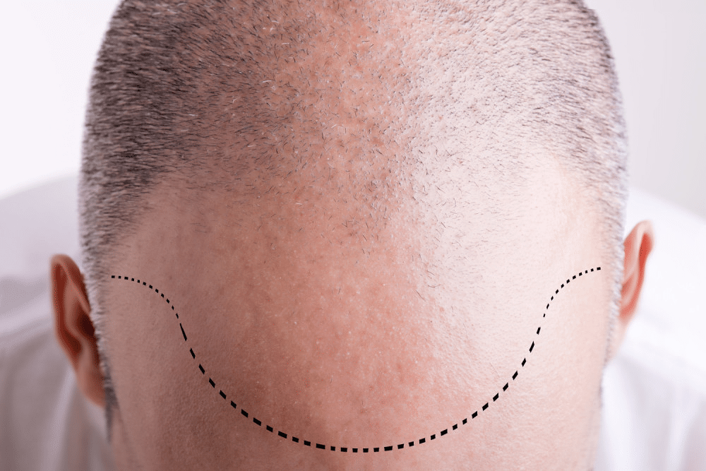 Image1_Robotic Hair Transplant Surgery (ARTAS): How it Works
