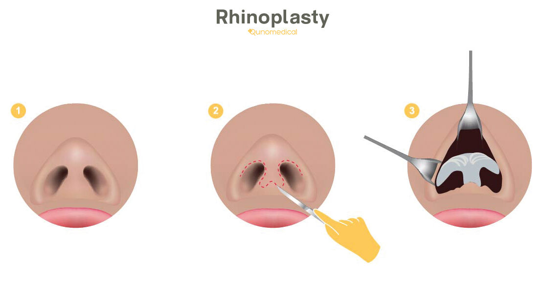 rhinoplasty-nose-job-procedure