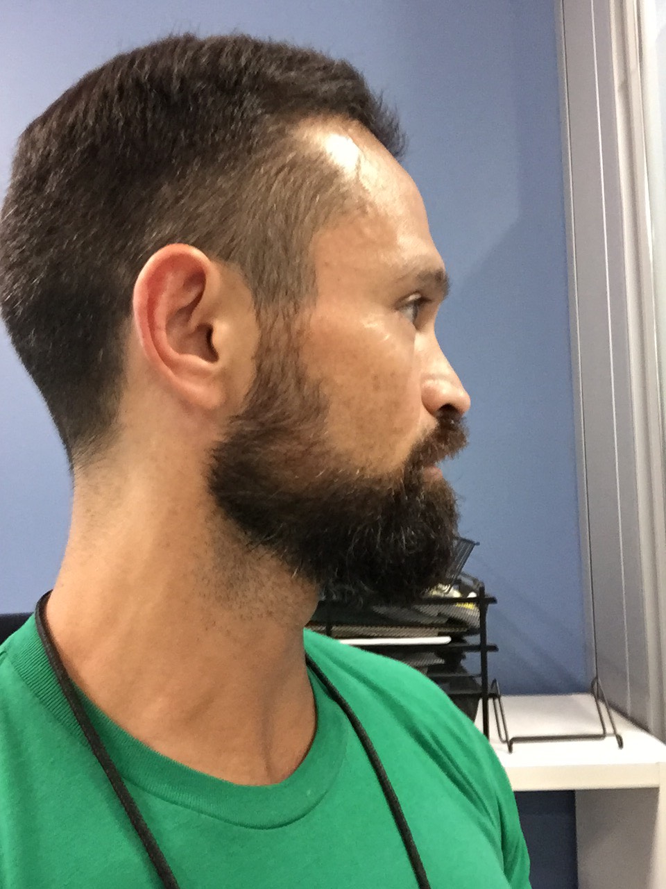 Image2_Freddy’s Hair Transplant: 6 Months Later