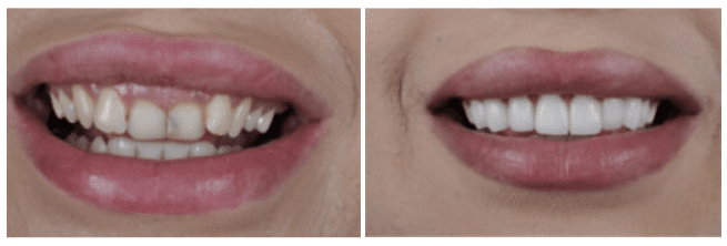 veneers-treatment-page_before-after-dentapoint