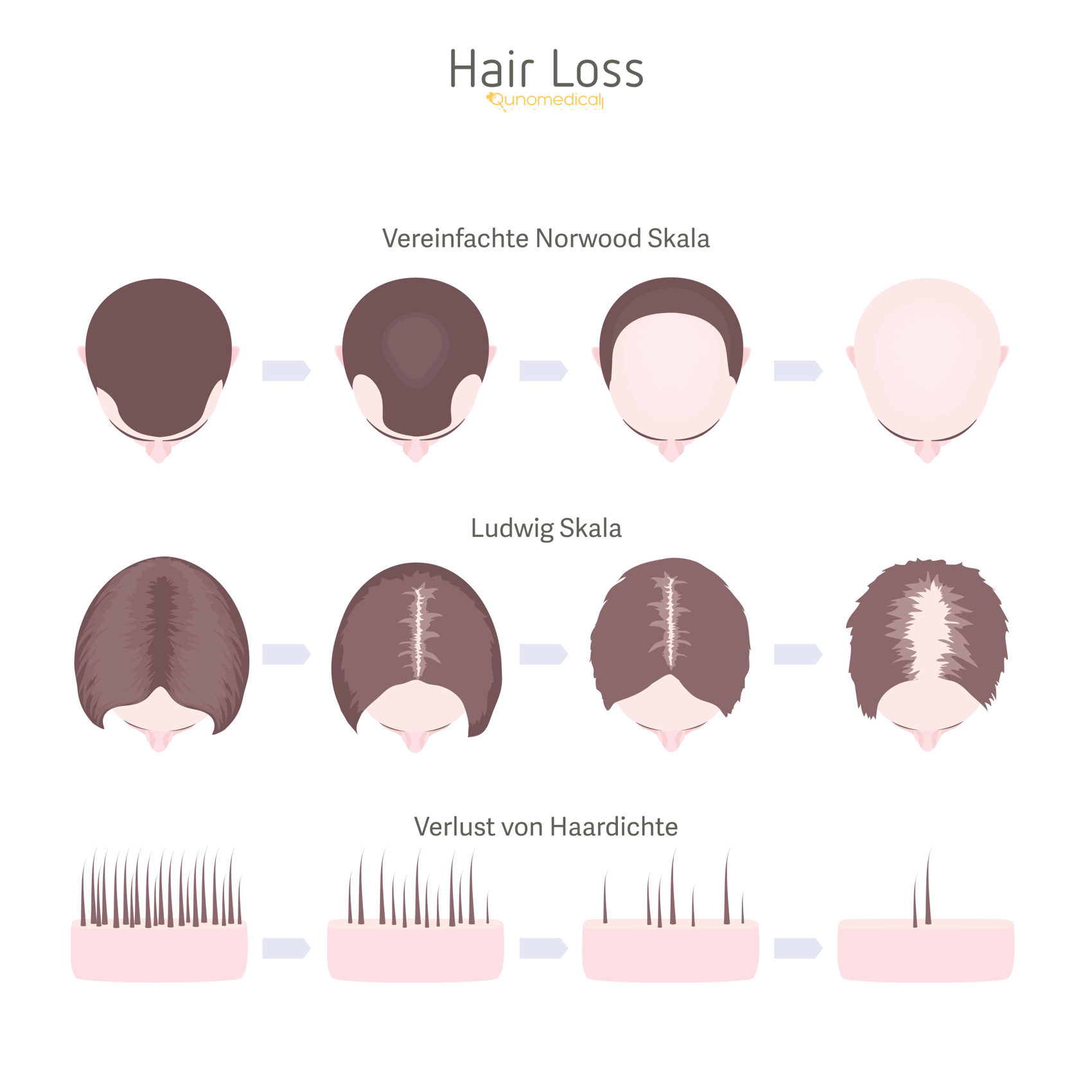 Illustration, die die verschiedenen Arten des weiblichen Haarausfalls zeigt.