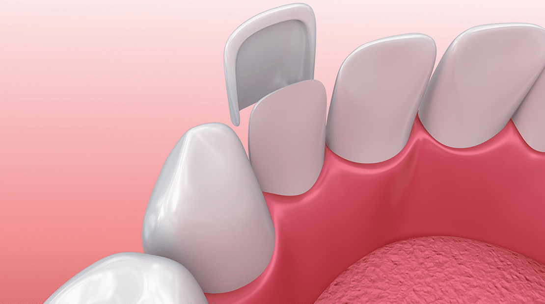 Image showing how a veneer is placed onto a tooth.