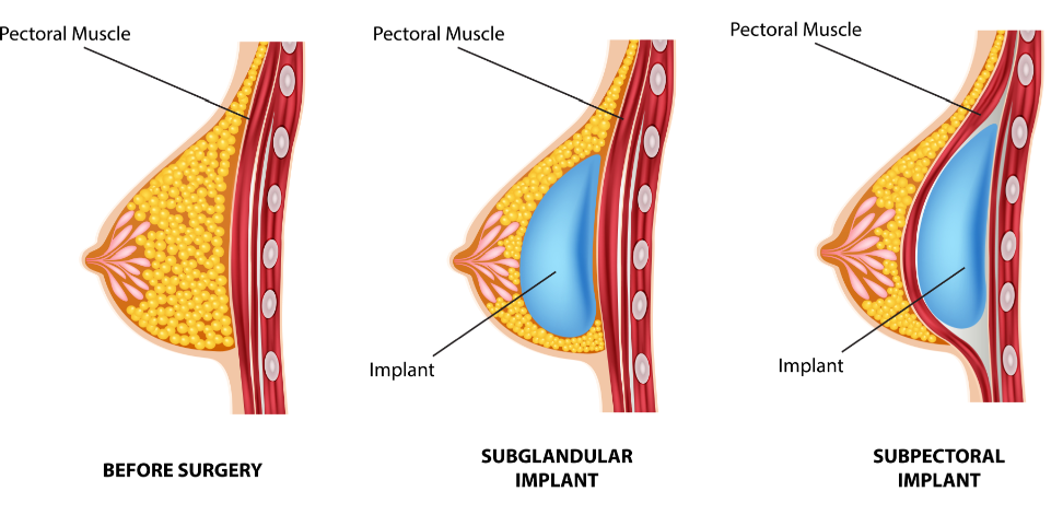 Image2_Breast Augmentation: Defining Treatments To Understand What Works For You