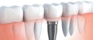 Diagram showing restorative dentistry treatment.