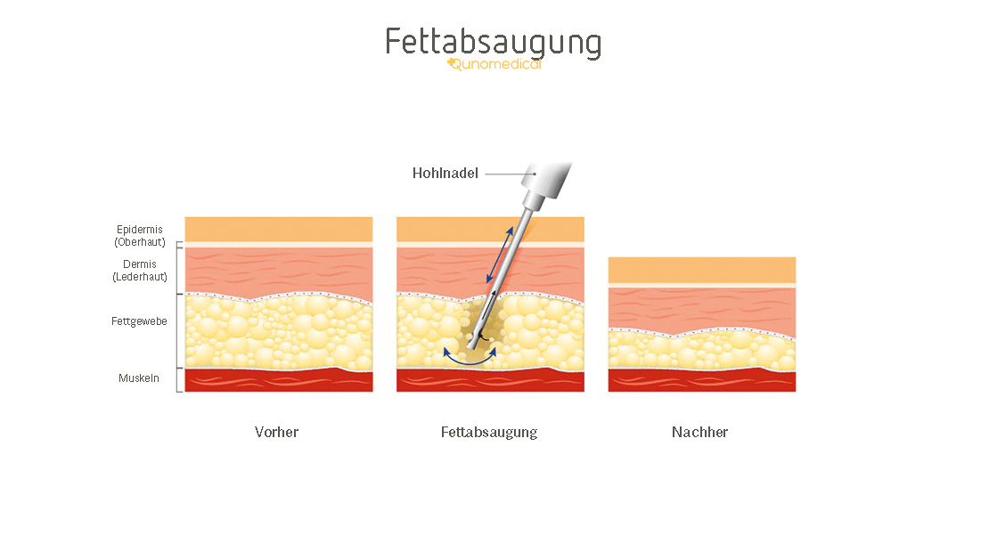 Diagramm, das zeigt, wie die Fettabsaugungs funktioniert.