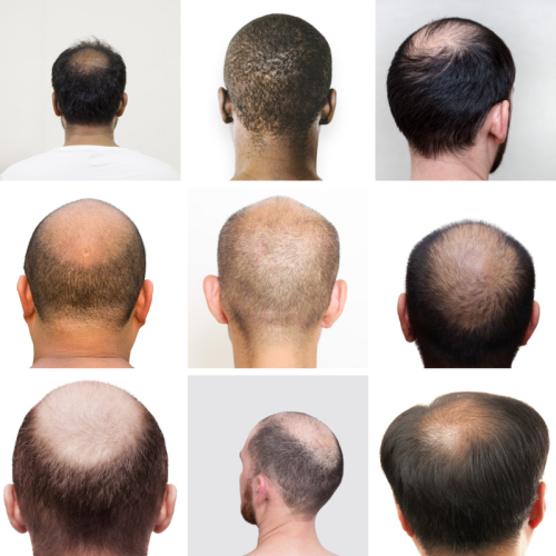 back of head different types of balding