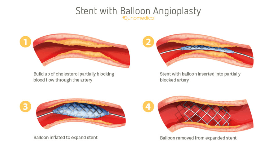 Balloon Angio Stent