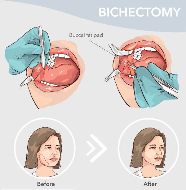 Übersicht über die Ergebnisse eines Bichetomie-Verfahrens