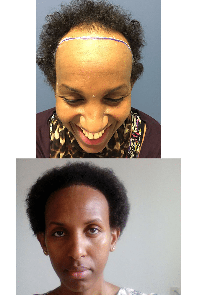 Image4_Hair Transplant and Afro Hair: Your Surgery Options