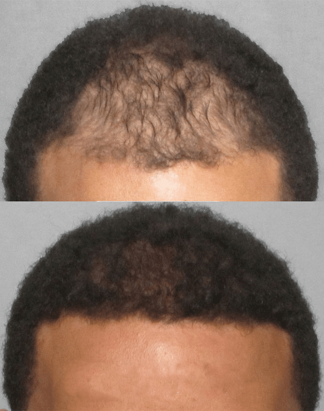 Afro hair transplant at Dr. Cinik Hair Hospital