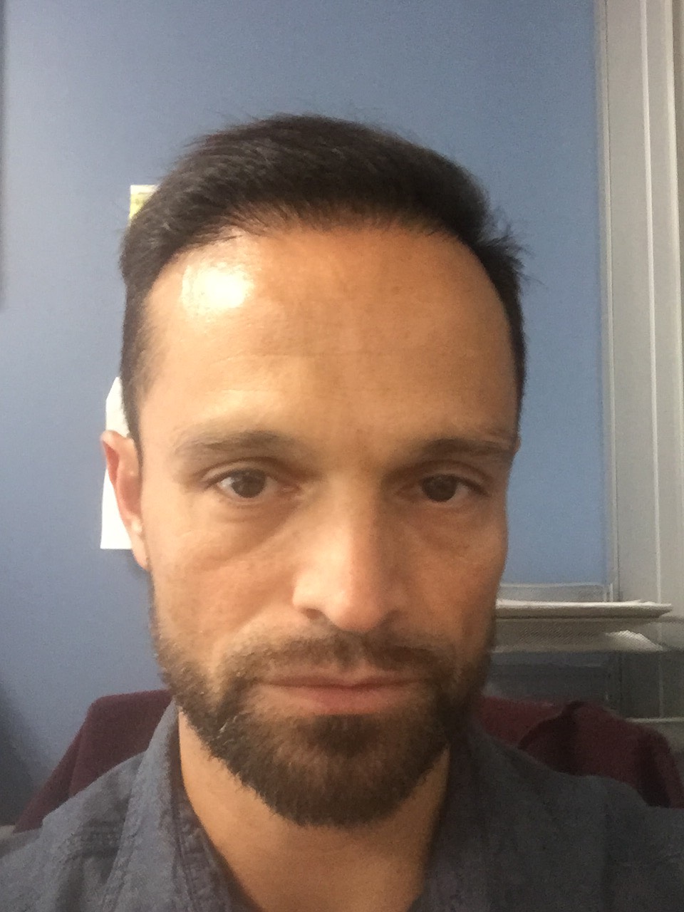 Image3_Freddy’s Hair Transplant: 6 Months Later