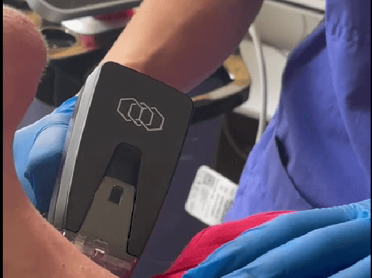Treatment with Morpheus8 tool