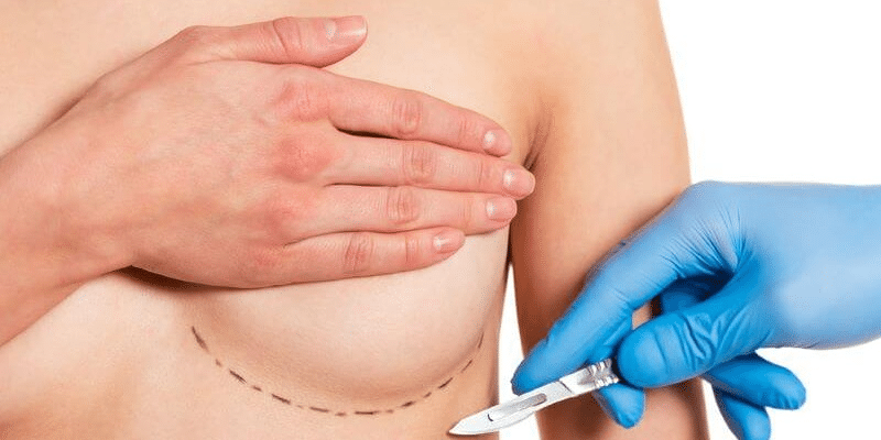 Breast reduction scars appear where the surgeon's incisions have closed up again.