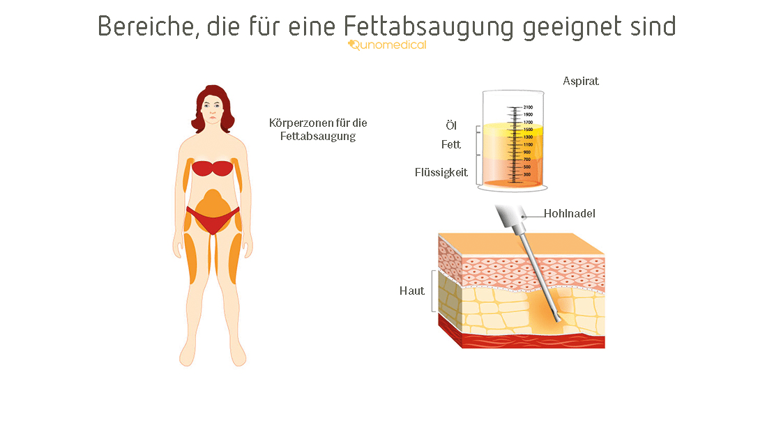 EN Gallery image 4 for mommy-makeover