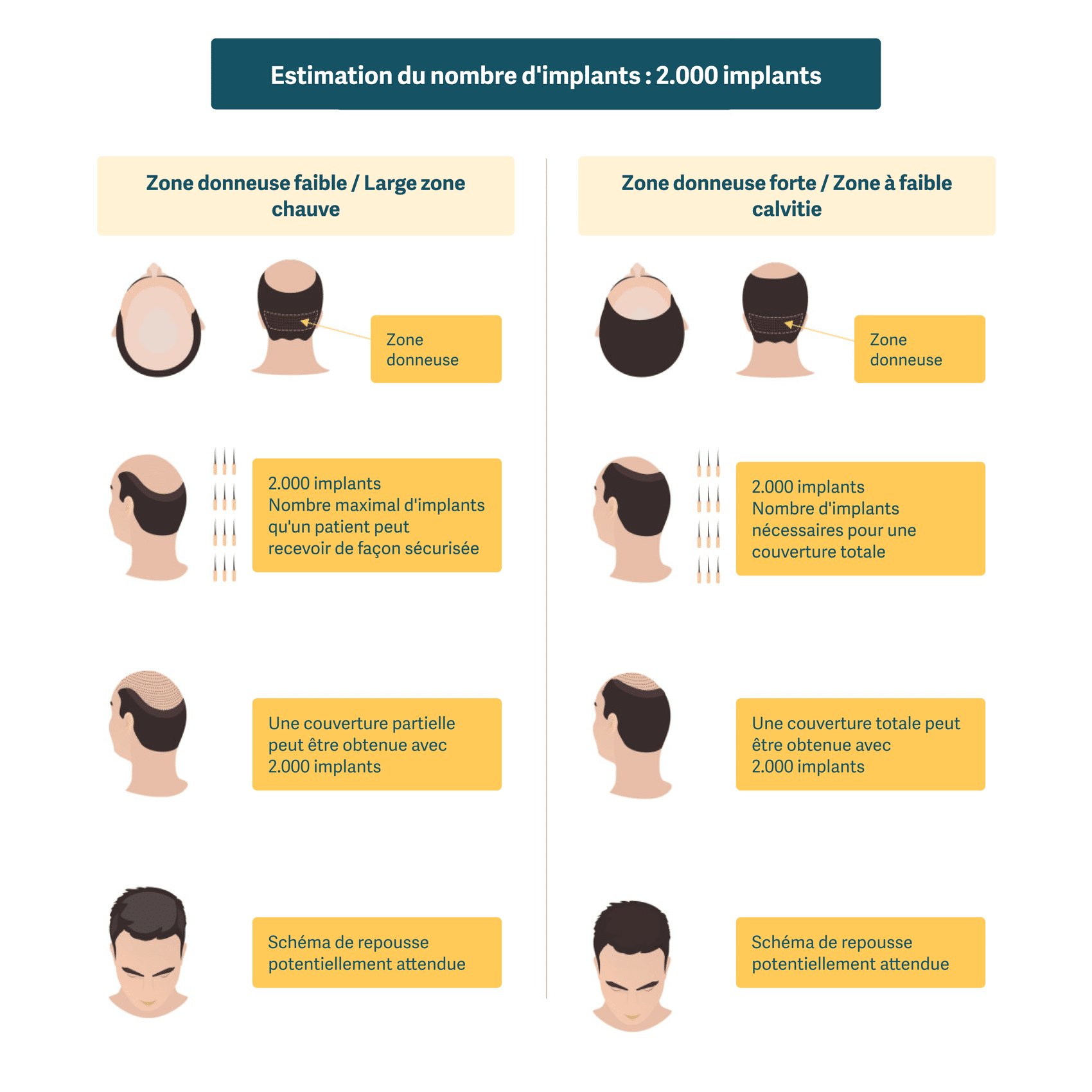 Illustration montrant les possibilités d'obtenir une couverture totale avec une greffe de cheveux de 2000 implants capillaires