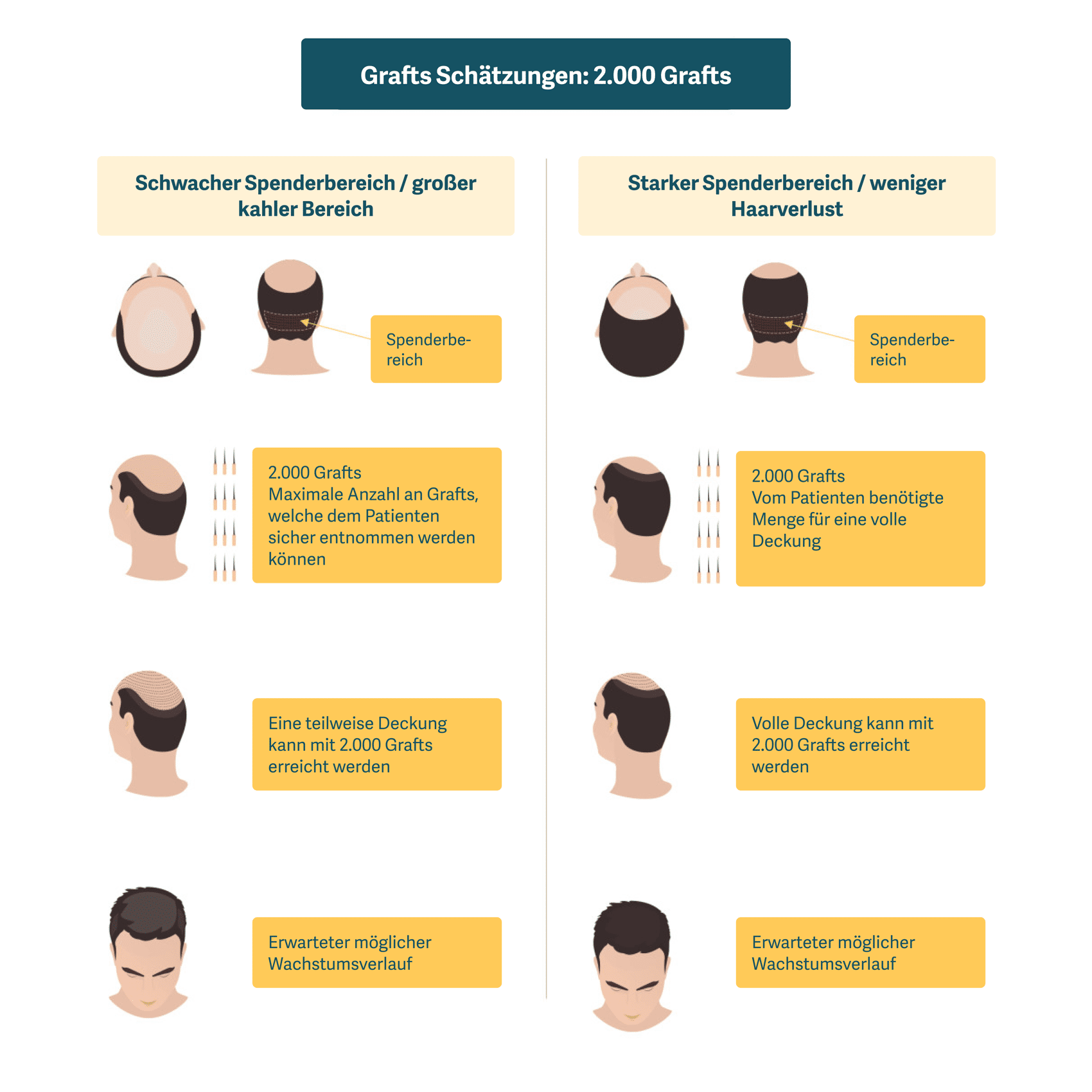 Illustration, die die Möglichkeiten zum Erreichen einer vollständigen Abdeckung durch eine 2.000-Graft-Haartransplantation zeigt.