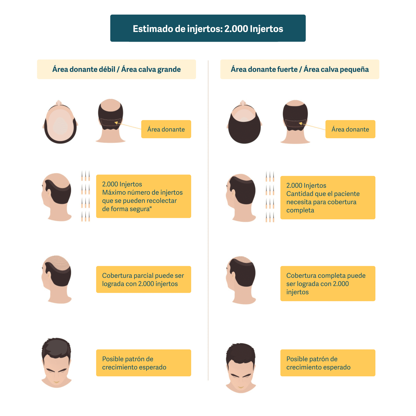 Ilustración que muestra las posibilidades de lograr una cobertura total de un trasplante de cabello con 2000 injertos.