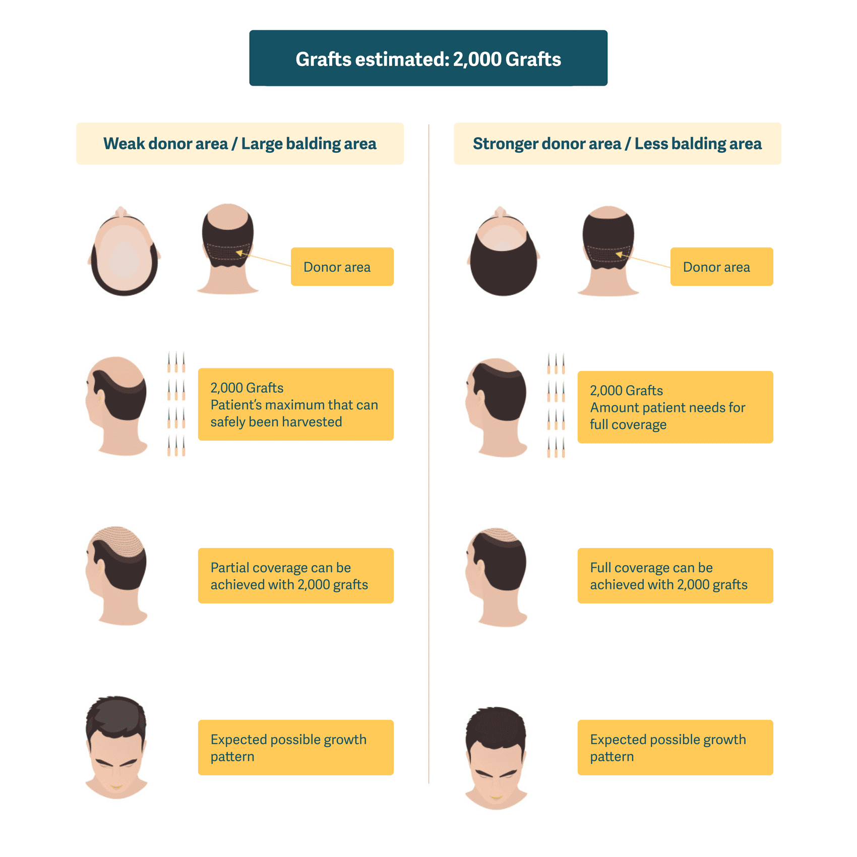 Illustration showing the possibilities of achieving full coverage from a 2,000 graft hair transplant.