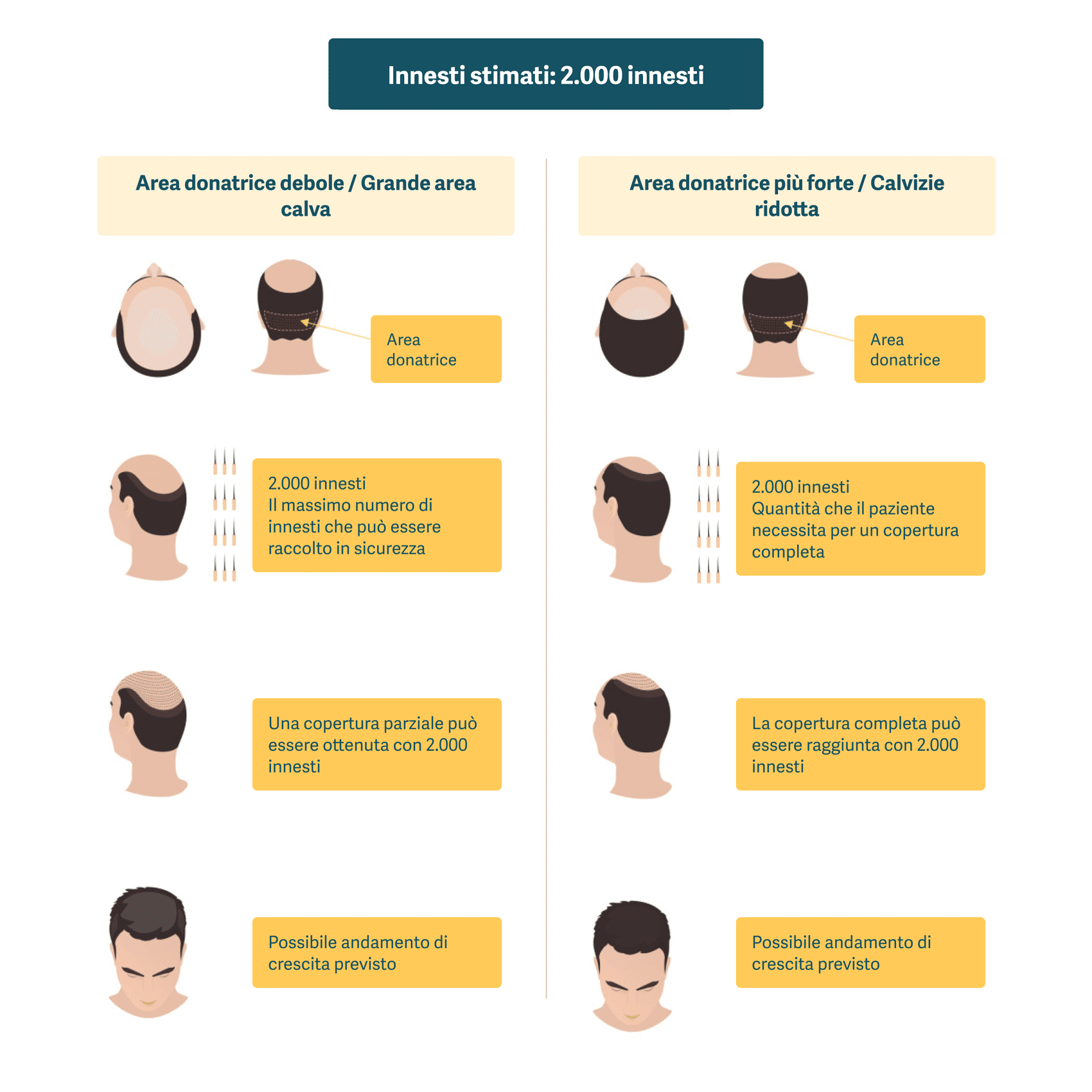 Illustrazione che mostra i gradi di copertura totale con un trapianto di capelli con 2000 innesti.